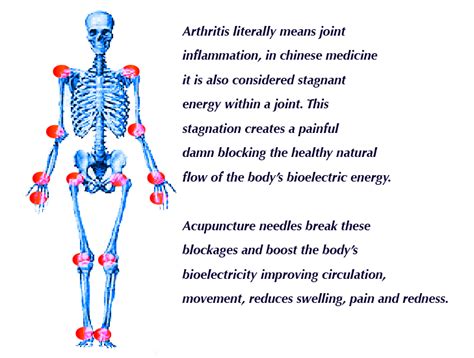 Acuthink: Acupuncture for Arthritis