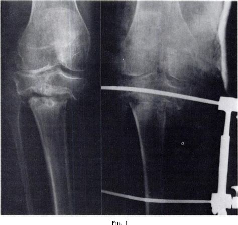 Figure 1 from Results of surgical treatment for non-union after high ...