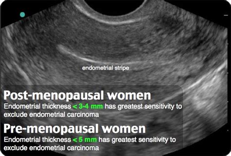 Endometrial Thickness