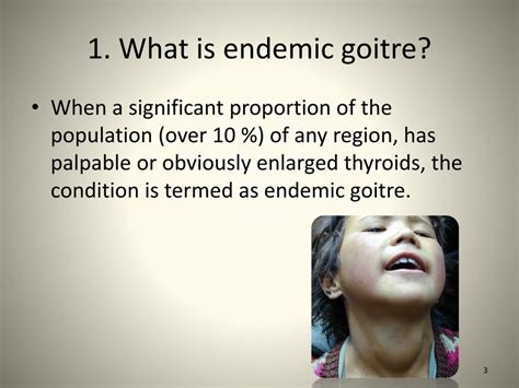 PPT - Endemic goiter in S ri L anka PowerPoint Presentation, free ...