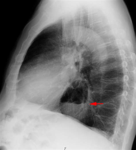 Hiatal Hernia (Stomach Hernia) — Diagnosis and Treatment | Lecturio