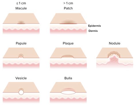 The Many Types and Causes of Foot Blisters - Blister Prevention