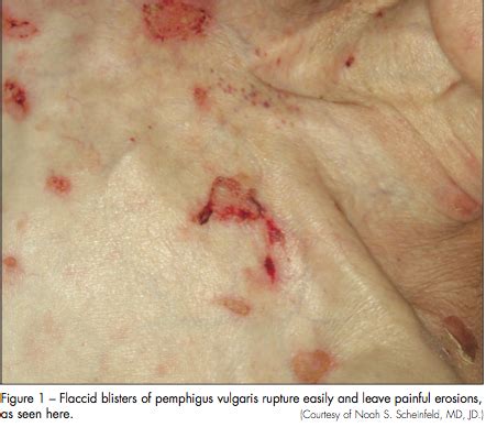 Skin Biopsy Techniques: When and How to Perform Punch Biopsy | Consultant360