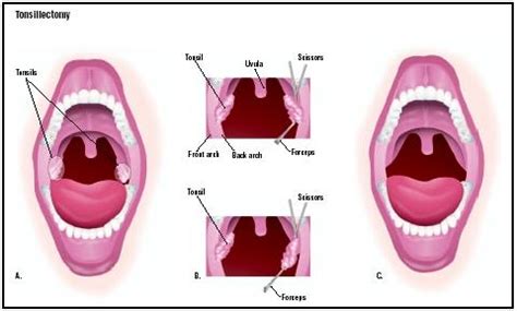 Operasi amandel adalah solusi terakhir - Radang Amandel & Radang ...