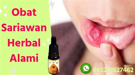 OBAT SARIAWAN HERBAL WA 081272451406 - YouTube