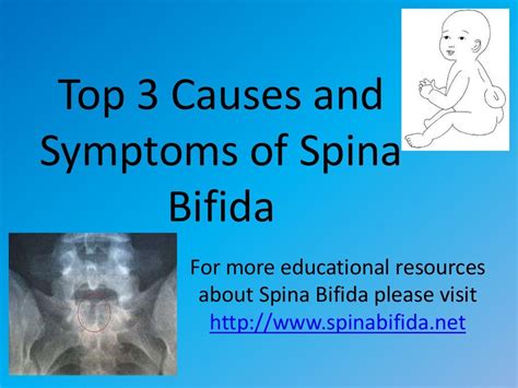 Top 3 causes and symptoms of spina bifida