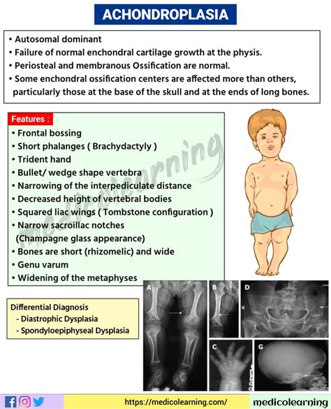 Achondroplasia – MedicoLearning