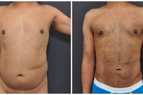 Liposuction for Men San Francisco | David Sieber, M.D.