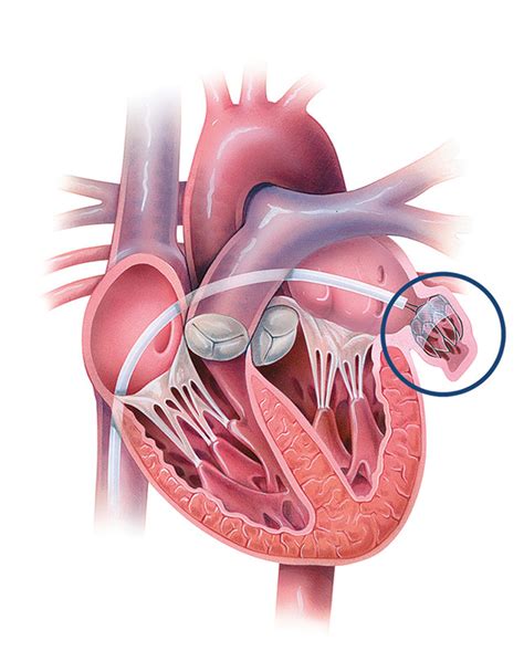 Left Atrial Appendage Closure Procedures | Johns Hopkins Medicine