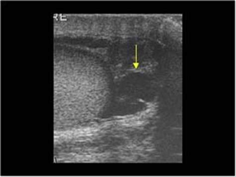 Urinary Tract and male reproductive system | 2.3 Scrotum : Case 2.3.2 ...