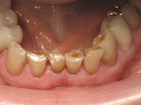 Show Your Work: Treating Incisal Edge Wear by Dr. Marvin Fier - Dentaltown