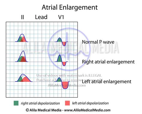 Alila Medical Media | Atrial enlargement ECG | Medical illustration