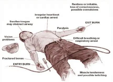 First Aid Treatment in Electric Shock - Causes, Sources, Severity