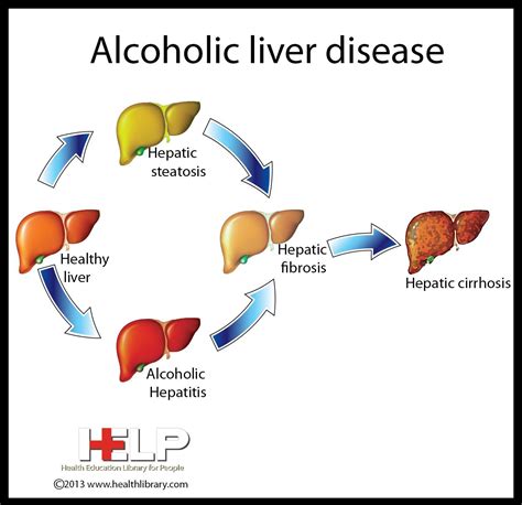 Alcoholic Liver Disease | Liver disease, Nursing information, Medical practice