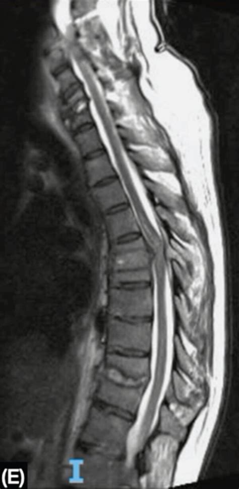 MRI showing the cervical, thoracic, and lumbar spine. (a, b) At the ...