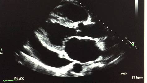 2D echocardiogram showing a large pericardial effusion - YouTube