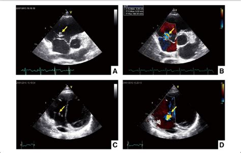 Figure. Trans-thoracic echocardiography (TTE) in a patient with ...