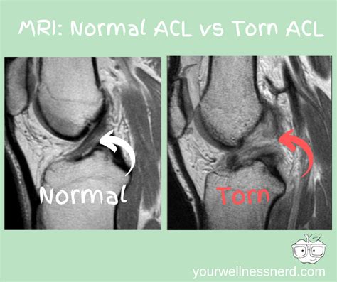 Comprehensive ACL Injury Guide: Why Mobilizing Your Ankles May Save Your Knees (ft. AFL Star Nic ...