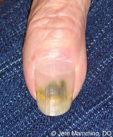 Green Nail Syndrome - American Osteopathic College of Dermatology (AOCD)