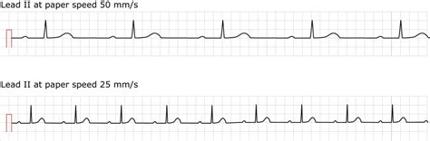 First-degree AV block (AV block I, AV block 1) – ECG learning