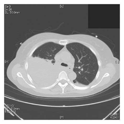 (a) Chest CT (POD 4). The scan shows a broad infiltrating shadow with... | Download Scientific ...