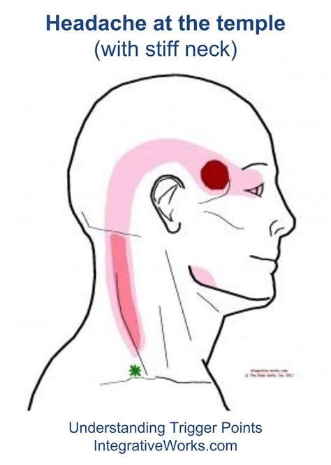 Resources for Pain Relief, Massage, and Bodywork | Trigger points, Headache, Migraine