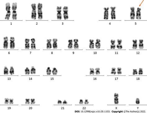 Neonatal Cri du chat syndrome with atypical facial appearance: A case report