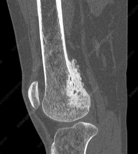 Bone cancer, CT scan - Stock Image C021/3184 - Science Photo Library