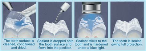 Fissure Sealants - Kinsale Dental