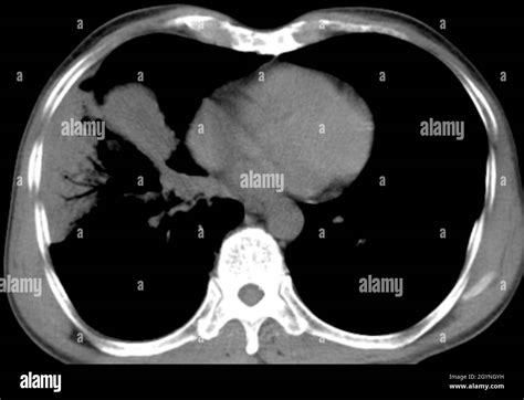 Early Lung Cancer Ct Scan