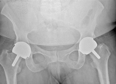 Metal-On-Metal Hip Arthroplasty – Development and Demise | Hughes | International Journal of ...