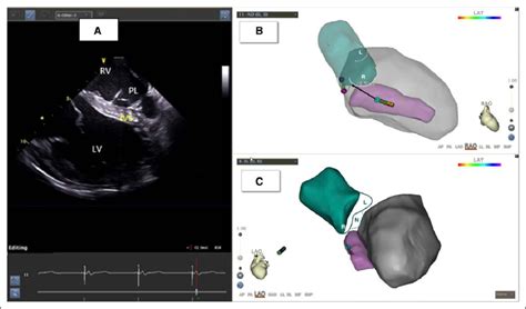 Implantation of the left bundle branch lead under intracardiac ...