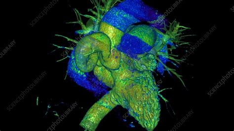 Aneurysm of the right coronary artery, rotating CT scan - Stock Video ...