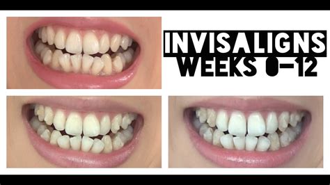 Invisalign Journey: Weeks 0-12 | YayForAmy - YouTube