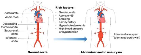 Life | Free Full-Text | Abdominal Aortic Aneurysm Formation with a Focus on Vascular Smooth ...