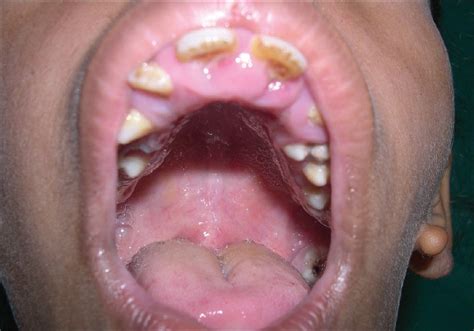 Goldenhar Syndrome - Causes, Symptoms, Treatment, Prognosis, Diagnosis ...