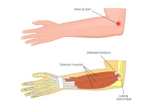 Tennis Elbow Surgery Tennis Elbow Lateral Epicondylitis Orthoinfo | Images and Photos finder