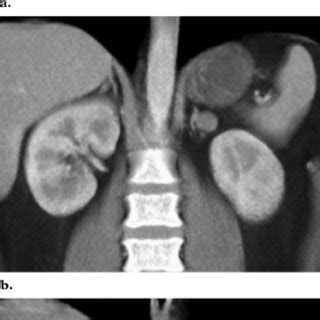 Lipid-poor adenoma in a 45-year-old woman who underwent CT for... | Download Scientific Diagram