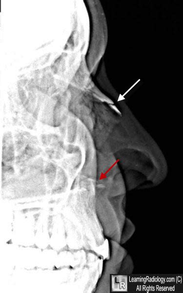 Nasal Fracture X Ray