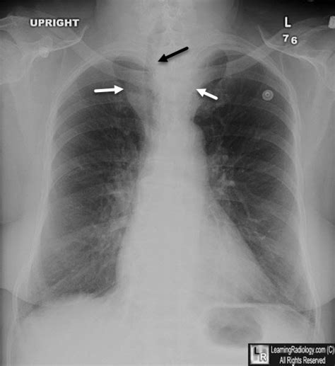 Thyroid Goiter Ultrasound