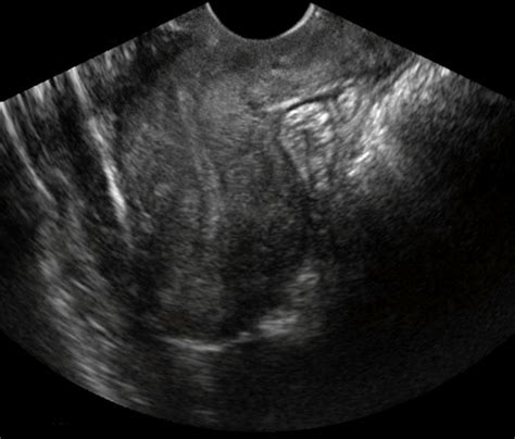 OB/Gyn Images | Ultrasound, Transvaginal ultrasound, Medical illustration