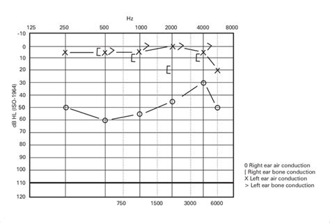 Otosclerosis Audiogram Carhart Notch