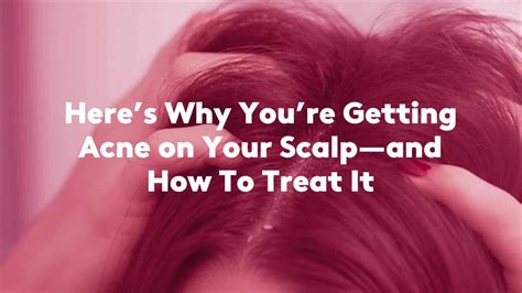 Treating Pimples on the Scalp: Causes, Remedies, and Prevention - Phonemantra