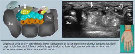 2 Carpal Tunnel Anatomy at the Level of the Pisiform (European Society... | Download Scientific ...