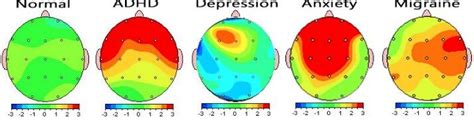 qEEG Brain Mapping — SWITCH