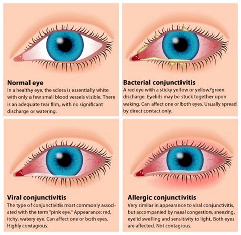 Pink Eye Treatment: 10 Proven Home Remedies For Conjunctivitis - Home ...