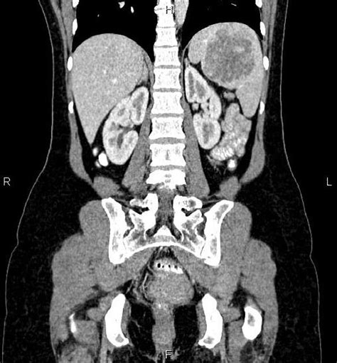 splenic hemangioma | pacs