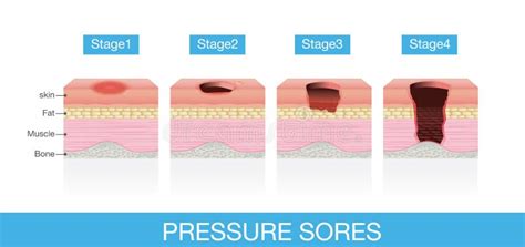 Stages of Pressure Sores stock vector. Illustration of medical - 63664147