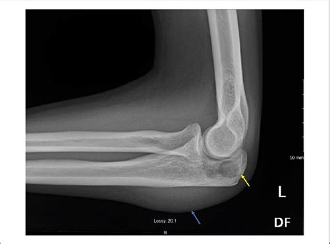 Olecranon Fossa X Ray