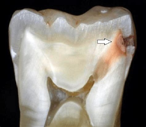 Dental caries in cross-sectional view | Download Scientific Diagram